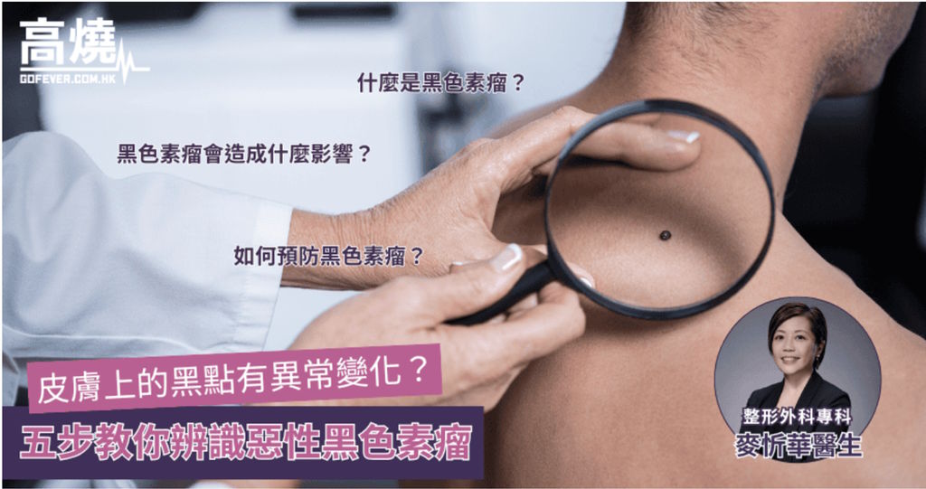【黑色素瘤】皮膚上的黑點有異常變化？五步教你辨識惡性黑色素瘤